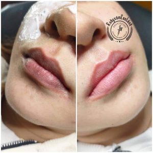 Dịch vụ khử thâm môi tại Ruby Phun Xăm Cao Lãnh